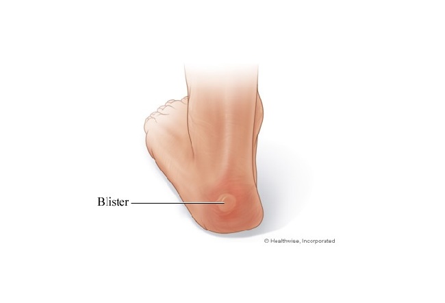 How to Avoid Blisters